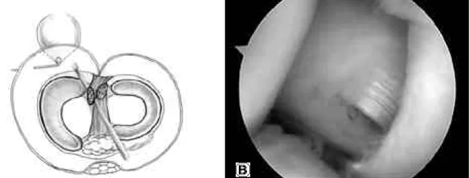 Fig. 3. When the opening of connection which is located just posteromedial side of medial head of gastrocnemius is visualized, it is enlarged about 8 mm by the  arthroscop-ic decompressive procedure of popliteal cyst using  bas-ket forcep at first and then