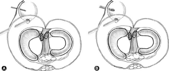 Fig. 4. The arthroscope is positioned at the posteromedial portal and advanced into popliteal cyst via enlarged opening to visualize the inside of popliteal cyst