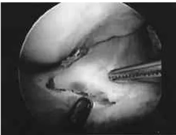 Fig. 1. Final reduction of the fragment was attempted by using the probe after through evacuation of the hematoma.
