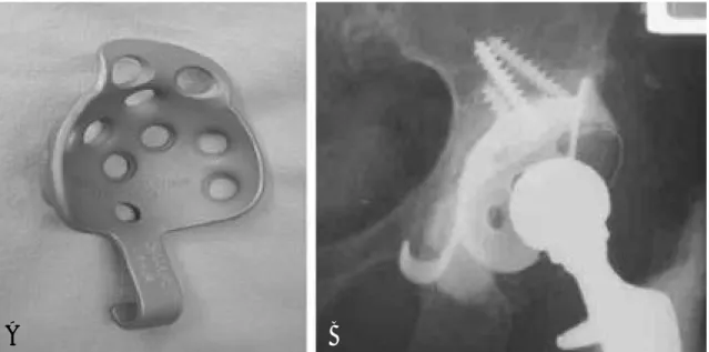Fig. 2. B: Muller reinforcement ring 을 이용한 비구컵재치환술예 ( 수술후 18 년 )