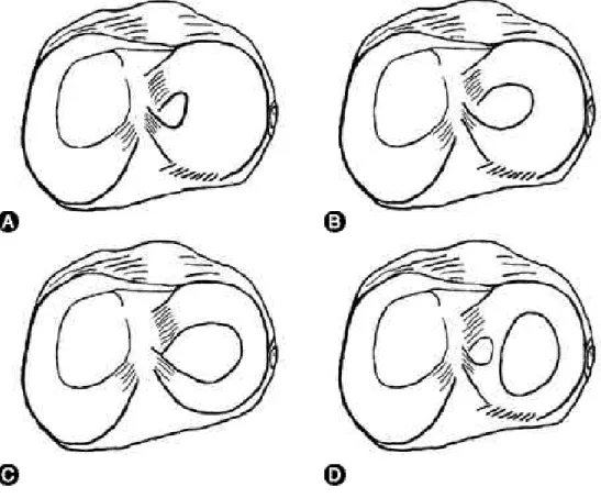 Fig. 1. Modified Watanabe’ s classification of lateral discoid meniscus. (A) Complete type