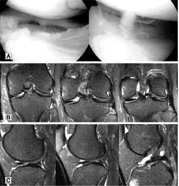 Fig. 3. (A) Central tear has irregular or degenerative inner margin which is not tapering and usually an average width of 6 to 8 mm in the lateral portion of discoid meniscus on arthroscopy