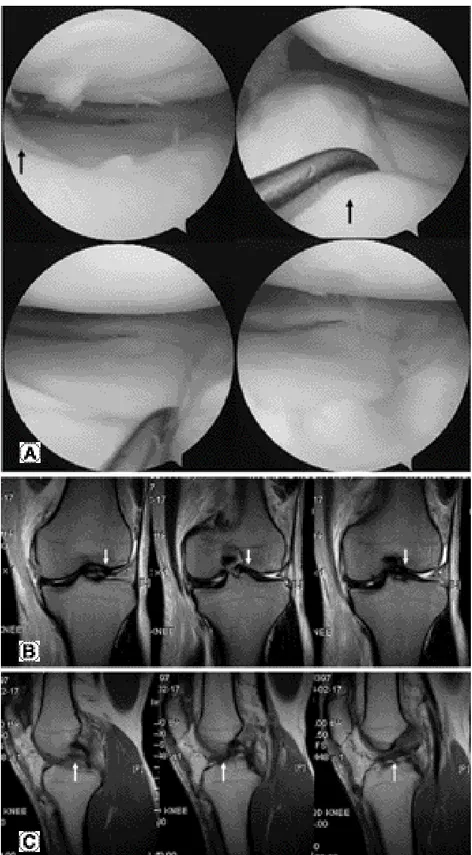 Fig. 4. (A) Ring-shaped lateral meniscus without any sign of a tear on arthroscopy. (B) Coronal MR images of the right knee show an abnormal shape of the lateral meniscus, mimicking a bucket handle tear of normal shaped lateral meniscus