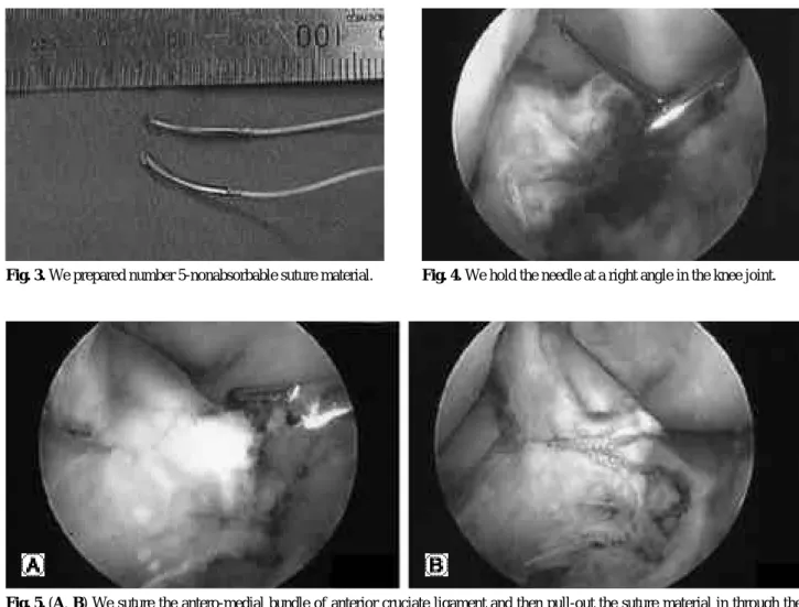 Fig. 3. We prepared number 5-nonabsorbable suture material.