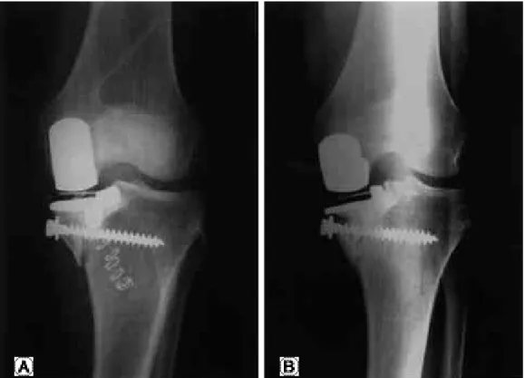 Fig. 1. (A) Initial postoperative radiograph of UKA with medial tibial condylar fracture treated by open reduction and screw fixation.