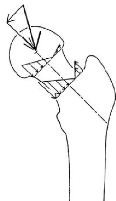 Fig. 3. The combination of bending and compressive stress in the femoral neck acts to decrease the tensile stress in the lateral aspect of the neck.