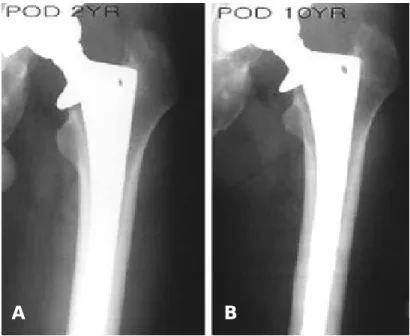Fig. 1. Radiographs made 10 years after operation shows well fixed stem without stress shielding and osteolysis.