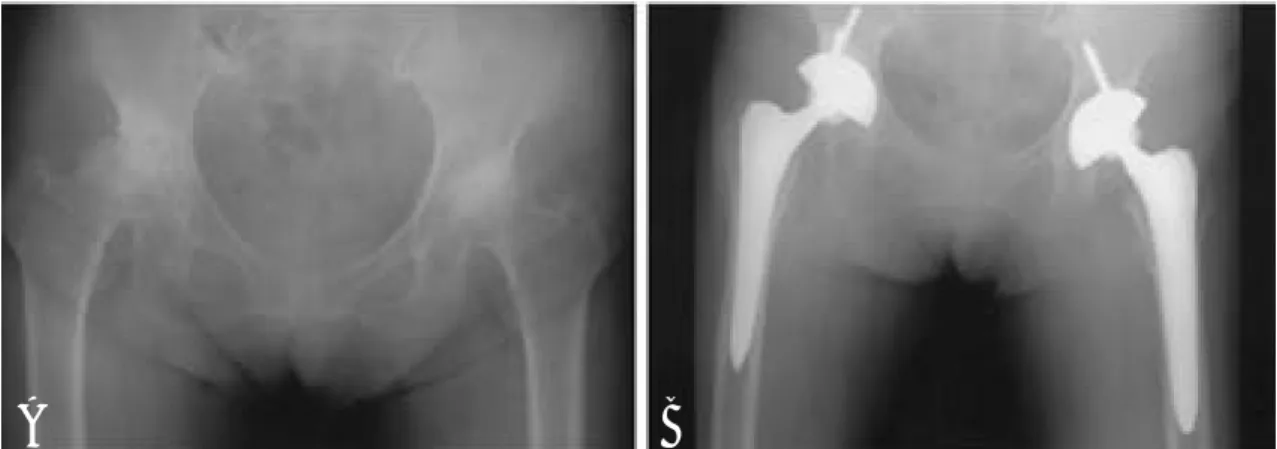 Fig. 2. A. Pre-operative radiograph demonstrats a degenerative arthritis in both hip due to the seqeule of developmen - -tal dysplasia of the hip.