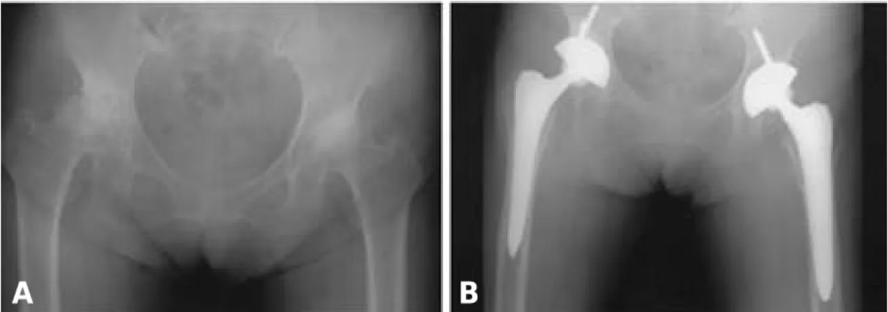 Fig. 2. A. Pre-operative radiograph demonstrats a degenerative arthritis in both hip due to the seqeule of developmen - -tal dysplasia of the hip.