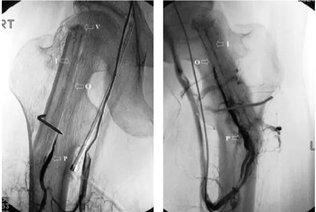 Fig. 1. DSA at postoperative 2wks showed well visual- visual-ization of peroneal pedicle(P) &amp; Intraosseous  cir-culation(I), periosteal circulation(O) c the  vascu-lar pooling(V) on the tip of grafted fibula.