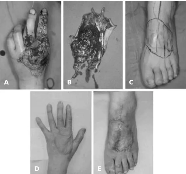 Fig. 1. Acute degloving injury of left hand dorsum which was associated with ruptures of 2nd, 3rd extensor tendons and fracture of 2nd phalanx