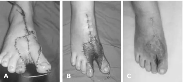 Fig. 3. Preserved superficial fat skin graft application to defect immediately after flap elevation and hemostasis