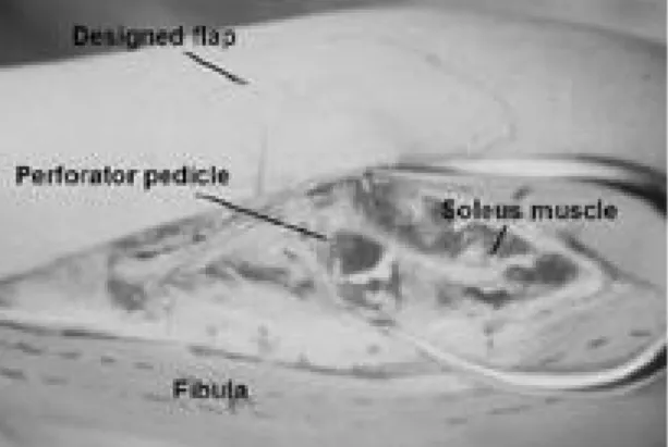 Fig. 2. We harvested peroneal perforator flap, 5×8 cm sized.  