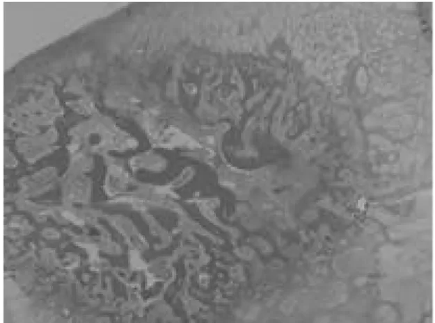Fig. 1. The postoperative anterior (A) and lateral (B) roentgenography of the left knee of 5 year-old male patient.