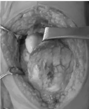 Fig. 6. Gross finding of the excised mass shows oval shaped, whitish colored, hard mass (size, 3 ×2 cm).