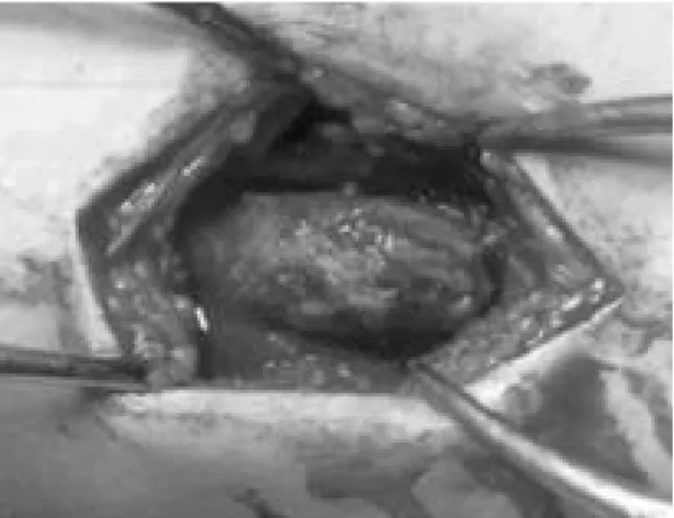Fig. 4. Histologic features of hypercellular cartilage with maturation to trabecular bone, a process of enchondral ossification