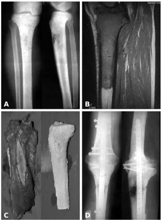 Fig. 1. Osteosarcoma of the right proximal tibia in a 44-year-old male. (A, B) Initial radiographs and MRI show patho- patho-logic changes of proximal tibia