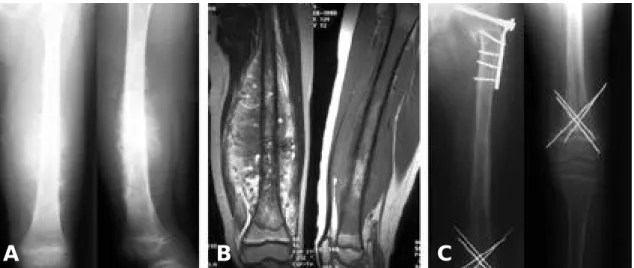Fig. 2. (A) Osteosarcoma of the left proximal humerus in a 26-year-old male. (B) After wide resection, soft tissue was peeled off and medullary canal was curetted