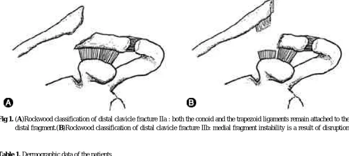 Fig 1. (A)Rockwood classification of distal clavicle fracture IIa : both the conoid and the trapezoid ligaments remain attached to the distal fragment.(B)Rockwood classification of distal clavicle fracture IIb: medial fragment instability is a result of di
