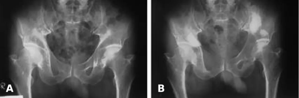 Fig 1. 45 year-old-male. Bladder cancer (A) Initial pelvis AP. Osteolytic lesions are shown on right acetabulum, right superior ramus and left ilium (B) Percutaneous bone cementation