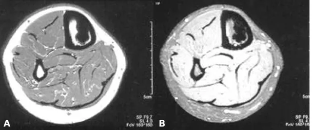 Fig. 4. Histologic findings of the mass reveal lamellar bone architecture with Haversian canals (H &amp; E,