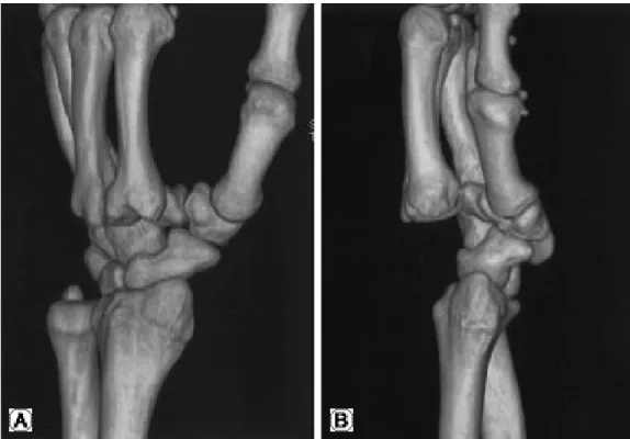 Fig. 2. Three-dimentional reconstruction views (A, B) of the wrist joint immediate after trauma.