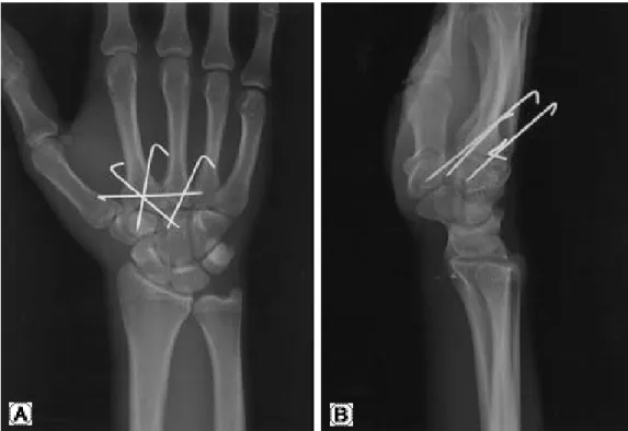 Fig. 4. Full range of motion of the wrist (A, B) after 13 months follow-up.