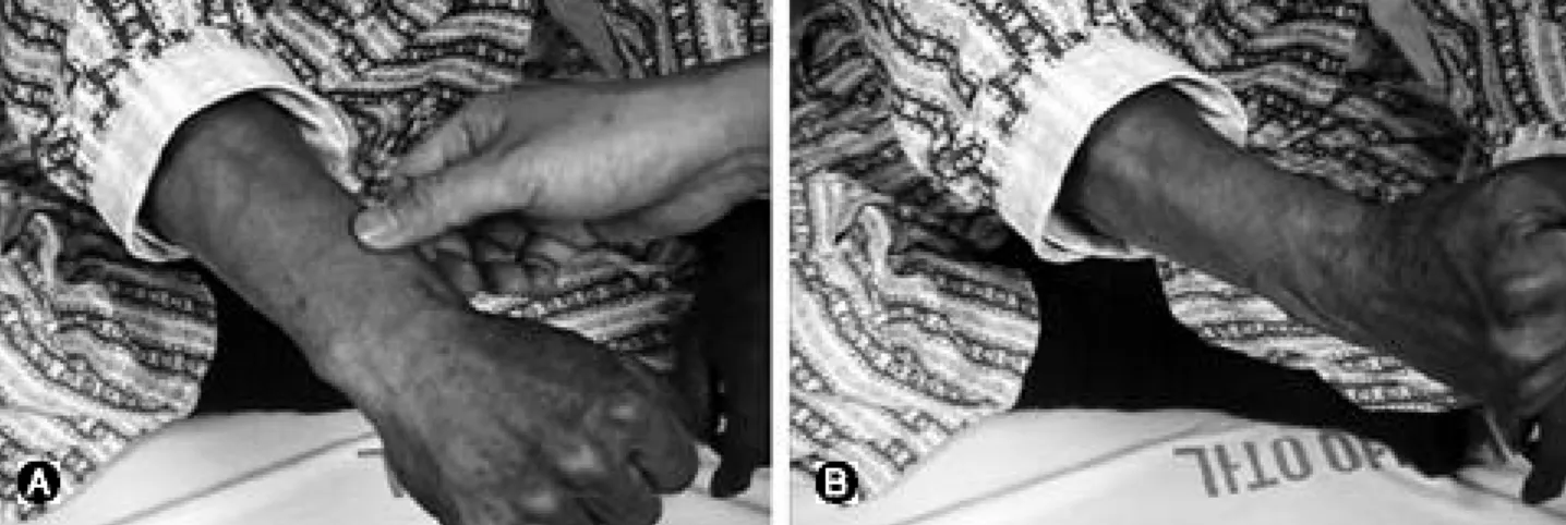 Fig. 1. (A) Examiner’ s thumb indicates the tender point. (B) It presents with pain and swelling in the area where the muscle bellies of the APL cross the ECRL and ECRB.
