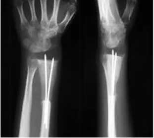 Fig. 2. Plain radiographs at immediate post-operation shows acceptable alignment of wrist.