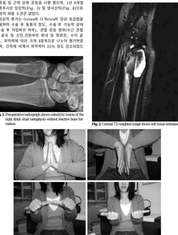 Fig. 1. Preoperative radiograph shows osteolytic lesion of the right distal ulnar metaphysis without reactive bone 