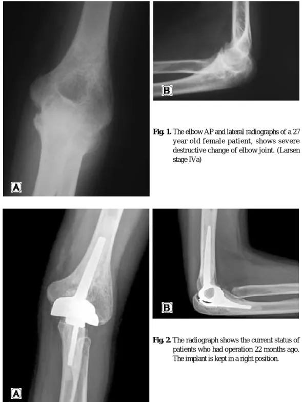 Fig. 1. The elbow AP and lateral radiographs of a 27 y e a r   o l d   f e m a l e   p a t i e n t ,   s h o w s   s e v e r e destructive change of elbow joint