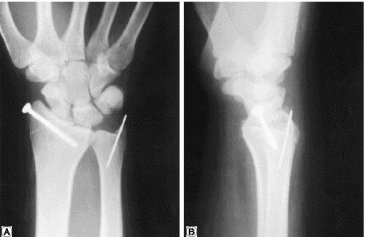Fig. 2. (A) and (B) Radiographs at 2 weeks after surgery show normal alignment of radiocarpal joint.