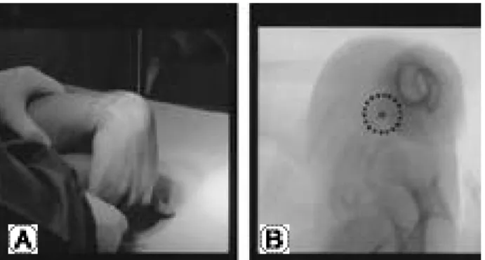 Fig. 2. (A) After identifying the proper position of the guide wire on the image intensifier, drill is introduced parallel to this guide wire into the centre of distal pole
