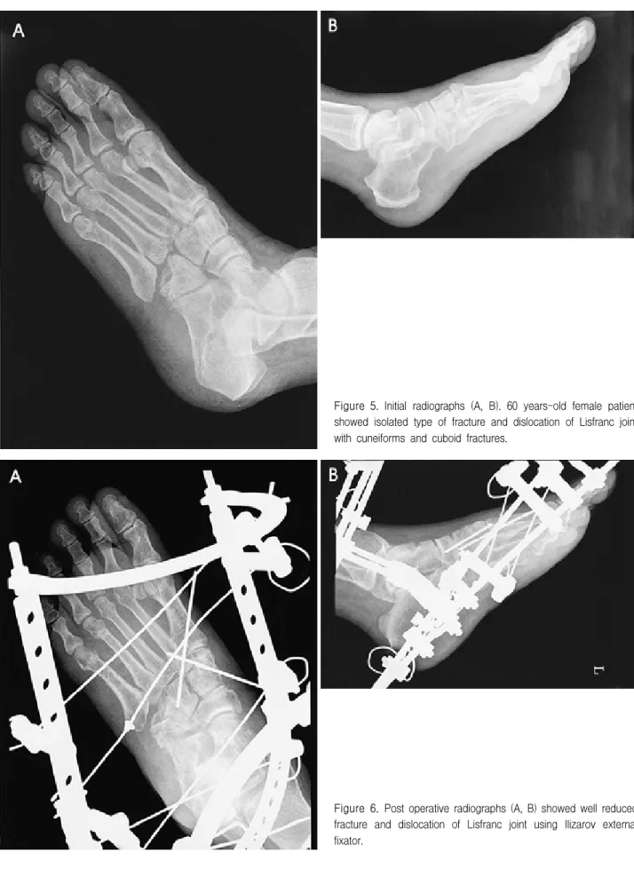 Figure 5. Initial  radiographs  (A,  B).  60  years-old  female  patient  showed  isolated  type  of  fracture  and  dislocation  of  Lisfranc  joint  with  cuneiforms  and  cuboid  fractures.