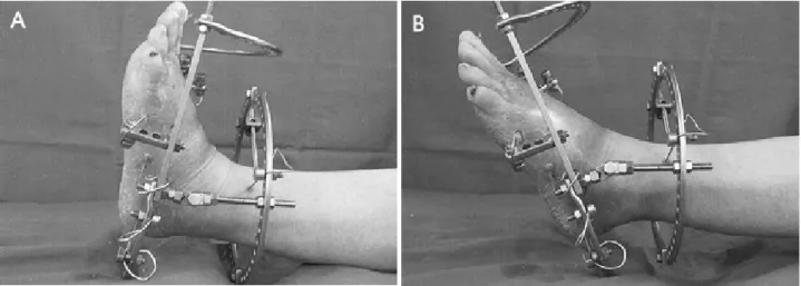 Figure 7. Photographs  (A,  B)  showed  active  ROM  exercise  of  ankle  joint  at  one  week  after  surgery.