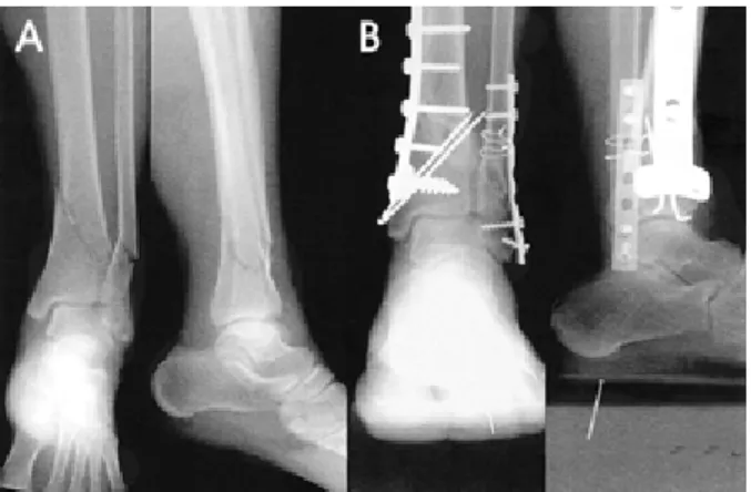 Figure 1. (A)  A  64  year  old  female  had  distal  tibial  fracture  (AO  type  A1)  and  Gustilo-Anderson  type  I  open  fracture  of  distal  fibula  due  to  traffic  accident