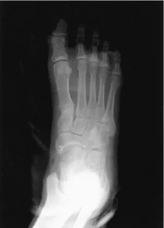 Figure 3. This  photograph  show  that  posterior  tibialis  tendon  is  attached  to  navicular  bone  with  Mitek  anchor.