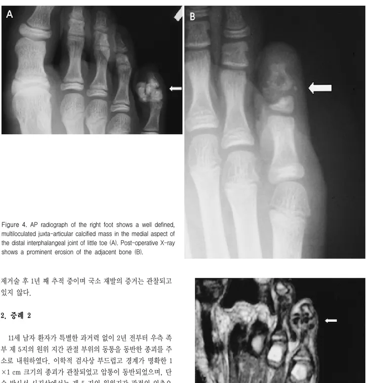 Figure 4. AP  radiograph  of  the  right  foot  shows  a  well  defined,  multiloculated  juxta-articular  calcified  mass  in  the  medial  aspect  of  the  distal  interphalangeal  joint  of  little  toe  (A)