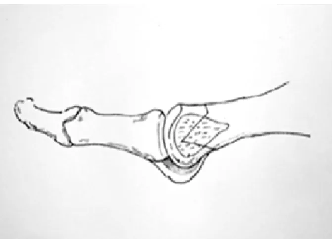 Figure 1. A  transverse  osteotomy  just  proximal  to  the  neck  made  with  depth  of  2  mm  perpendicular  to  long  axis  of  the  metatarsal  (Lateral  view).