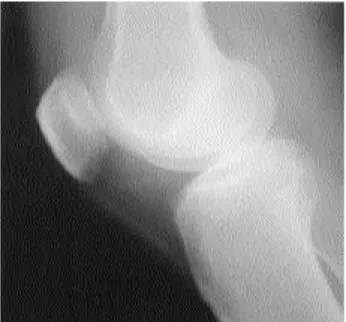 Fig. 1. Simple radiograph shows nonspecific finding and mod- mod-erate joint swelling.