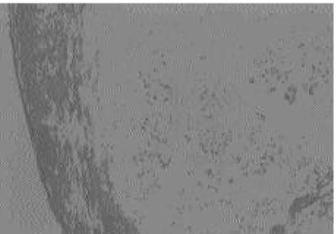 Fig. 5. Grossly shows 2.5 x 1.5 x 1 cm sized lobulated mass covered with hyaline cartilage.