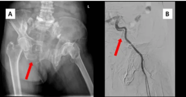 Fig. 1. (A) Pelvic fracture was shown in simple pelvic  radiography (red arrow). (B) Internal iliac artery  embolization (red arrow) was done and computed  tomography (CT) scan was omitted.