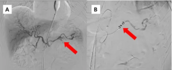 Fig. 1. Abdominal CT scan on arrival. (A) Blue arrow  indicates laceration of the distal pancreas and red  arrow indicates extravasation around the splenic  artery