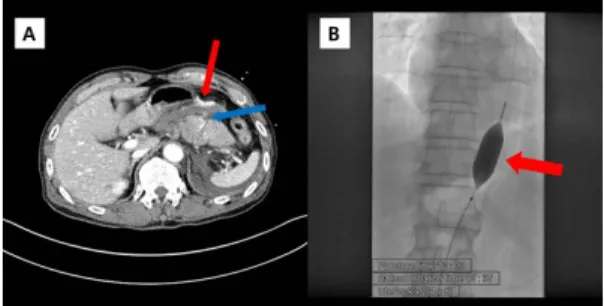 Fig. 2. Angiography. (A) Extravasation from the splenic  artery (red arrow). (B) Coil embolization (red  arrow) 