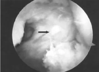 Fig. 3B. After cystectomy, normal anatomical structure of pos- pos-terior surface of the PCL (arrow) was shown.