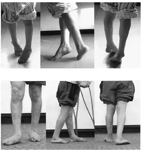 Figure 1. 41  years-old  man  has  difficulty  in  walking  with  spastic  paraplegia  which  resulted  in  dynamic  equinovarus.