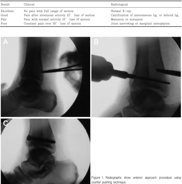 Figure 1. Radiographs  show  anterior  approach  procedure  using  counter  pushing  technique.