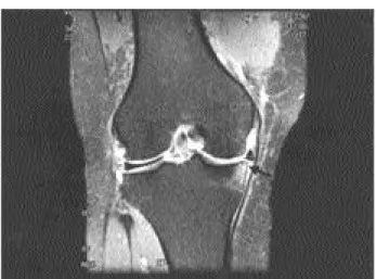 Fig. 1. A coronal T2-weighted MR image demonstrates a typi- typi-cal bone contusion in the midpoint of medial tibial plateau and meniscotibial ligament tear(arrow).