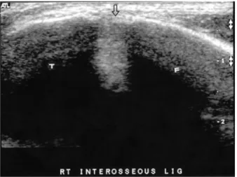 Figure 2. Ultrasonograph  of  ankle.  Sonography  can  show  interosseous  ligament.  T;  tibia,  F;  fibula.