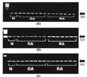 Fig. 1. (A) Internal control using  β-actin. ( B) The expression levels of NF-κ B were the highest in synovial tissues obtained from patients with RA.